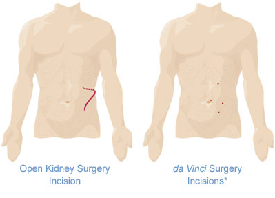 Kidney surgery incision comparison
